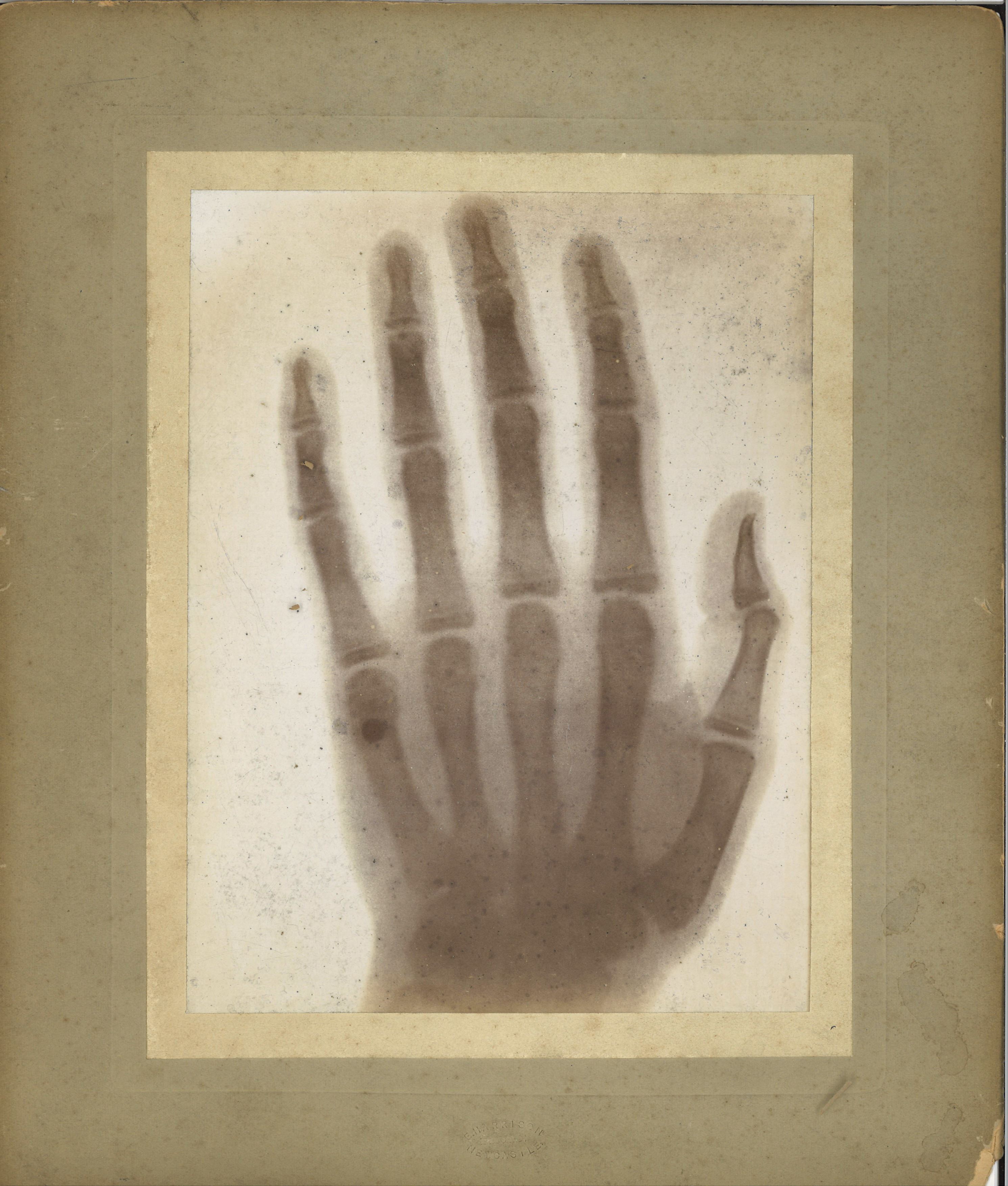 An image of an X-ray showing a hand.